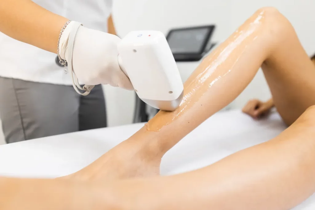 Everything about laser hair removal