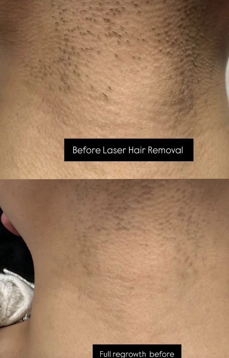 Clinix Quatrix Treatment Result 1