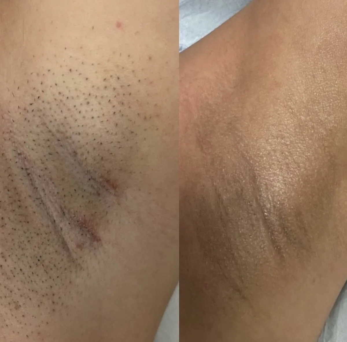 Clinix Quatrix Treatment Result 2