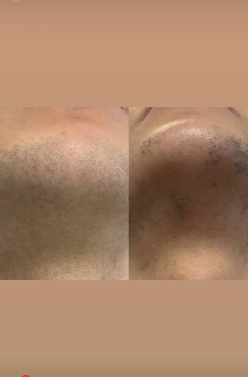 Clinix Quatrix Treatment Result 3