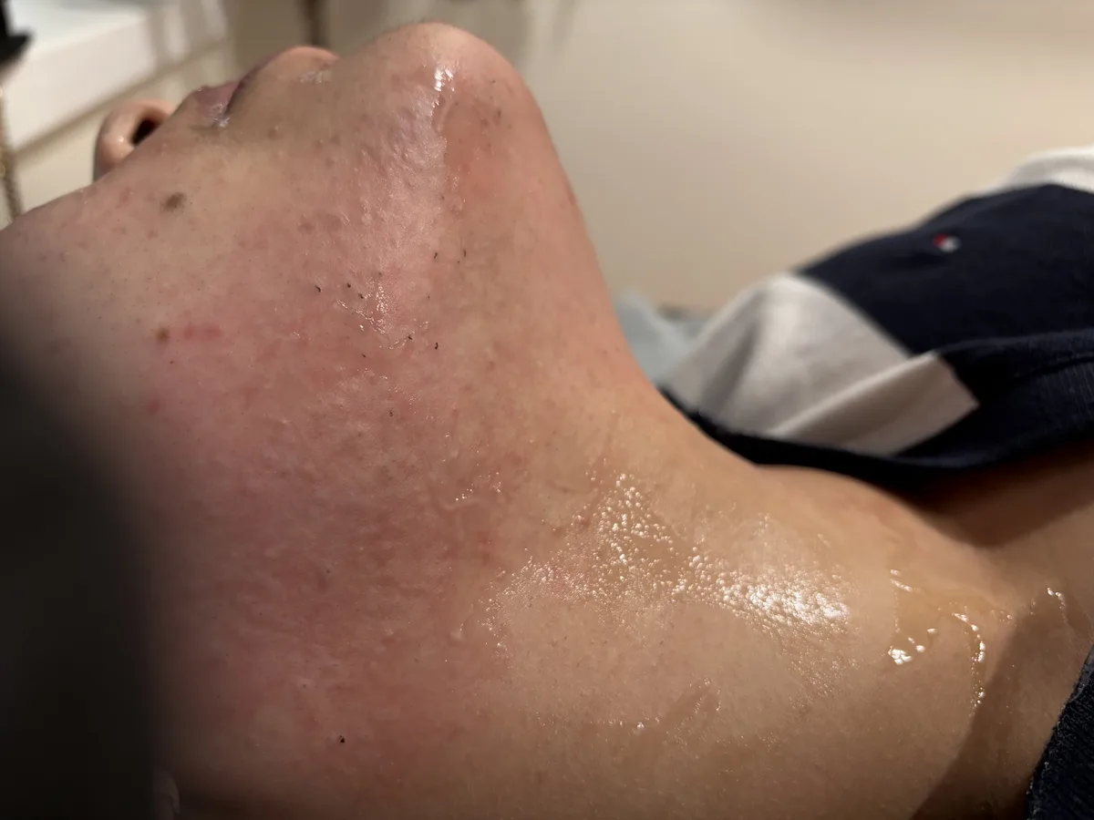 Clinix Quatrix Treatment Result 5