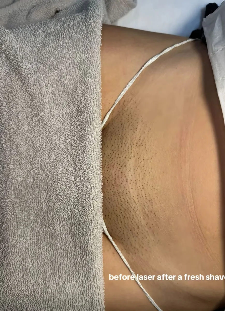 Clinix Quatrix Treatment Result 6